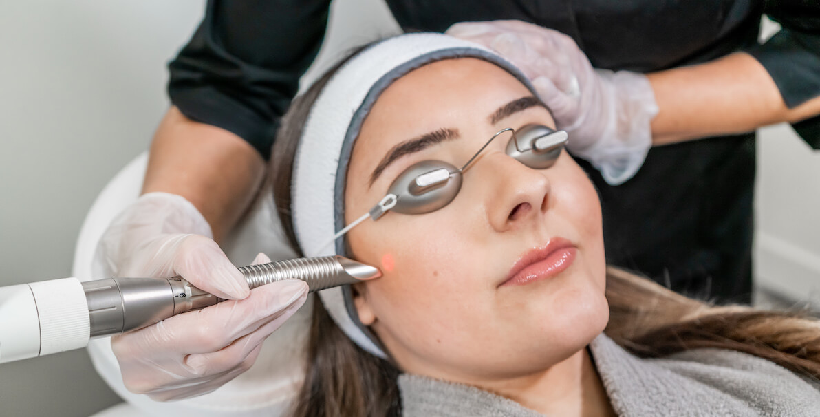 erbium yag laser peel in surrey on face skin treatment