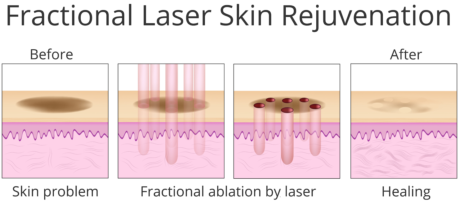 Fractional laser skin resurfacing diagram showing hole punctures made by laser to induce collagen and healing