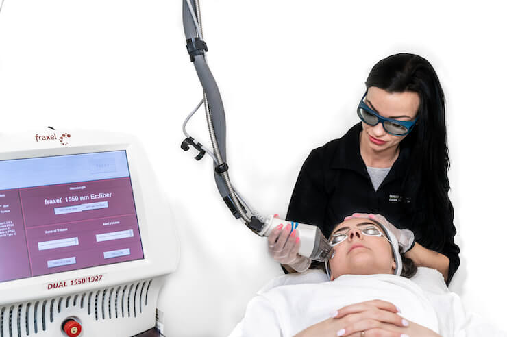 fraxel laser used by a beauty technician on a female patient for skin rejuvenation in surrey bc