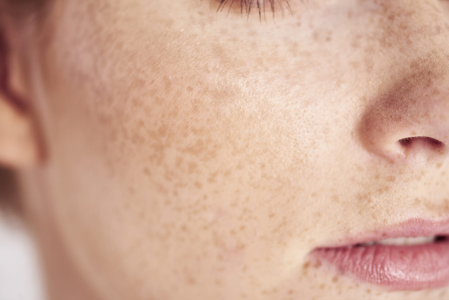 Close up of freckled skin on face of female caucasian skin - pigmentation example