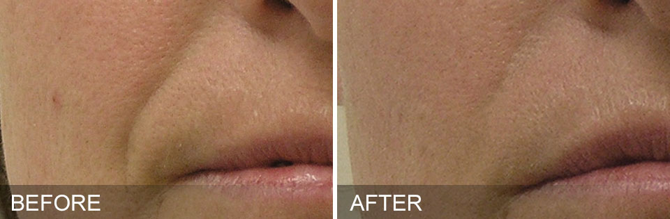 HydraFacial nasolabial folds - mouth smile lines - before and after reduction