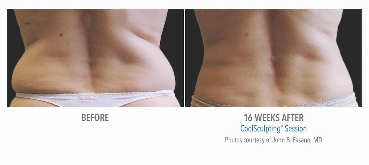 hip fat removal with coolsculpting machine - before and after photos