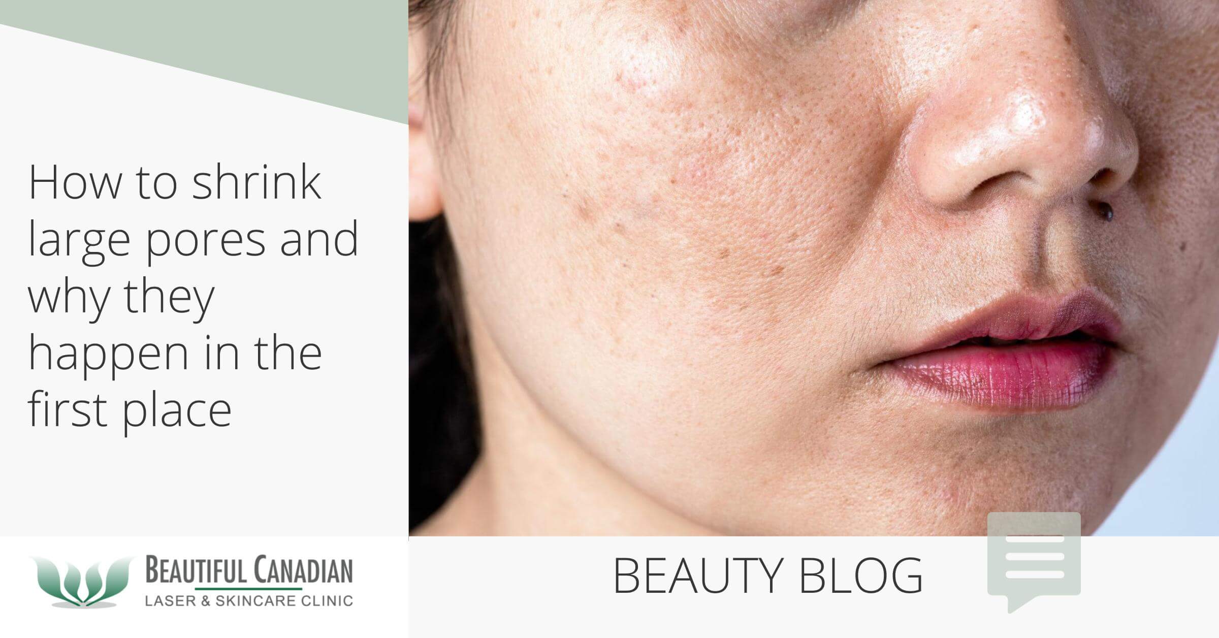 Enlarged pores cheeks
