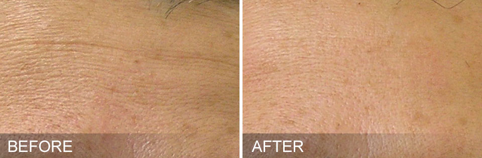 HydraFacial fine lines treatment before and after