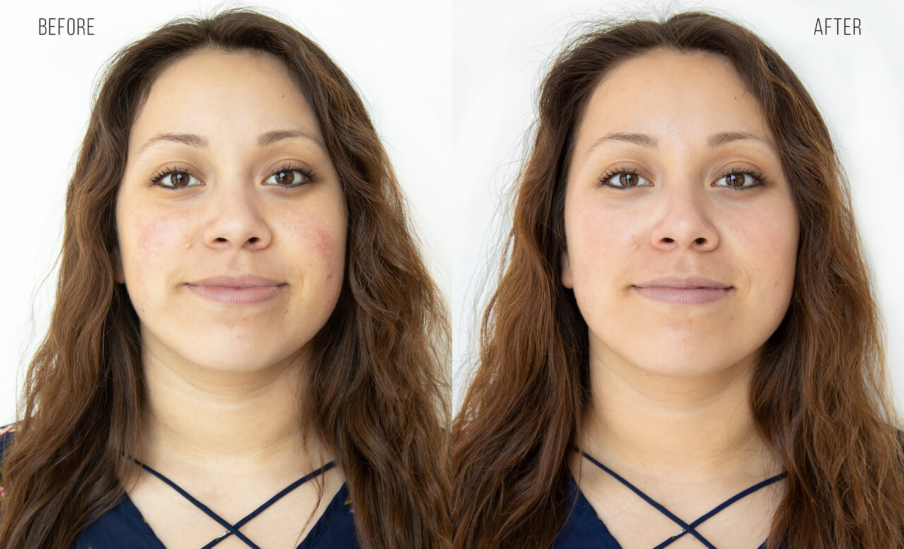 HydraFacial before and after photo of redness treated after the facial