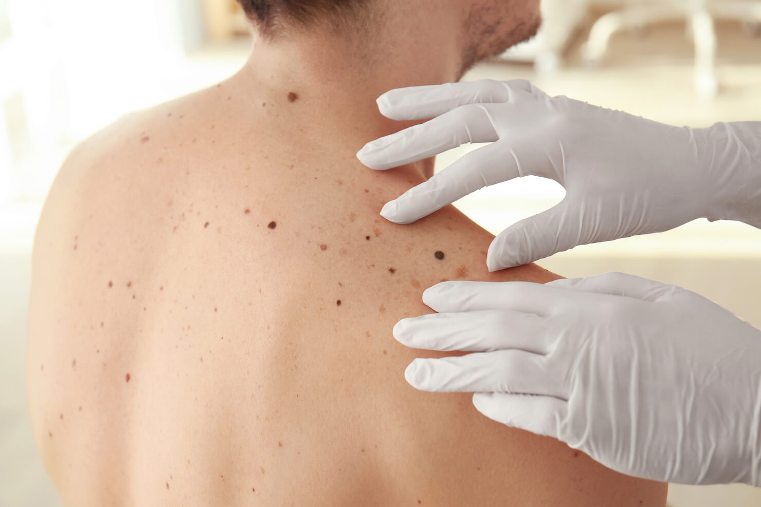 Doctor inspecting moles on male back for mole removal treatment