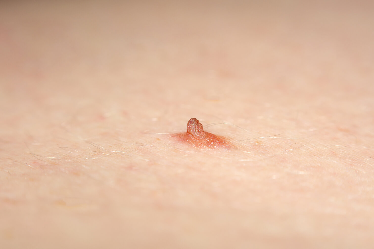 Intradermal nevi red or pink mole or skin tag forming a red spot