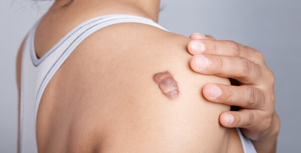 keloid scar on woman's shoulder suitable for cortisone injection scar removal