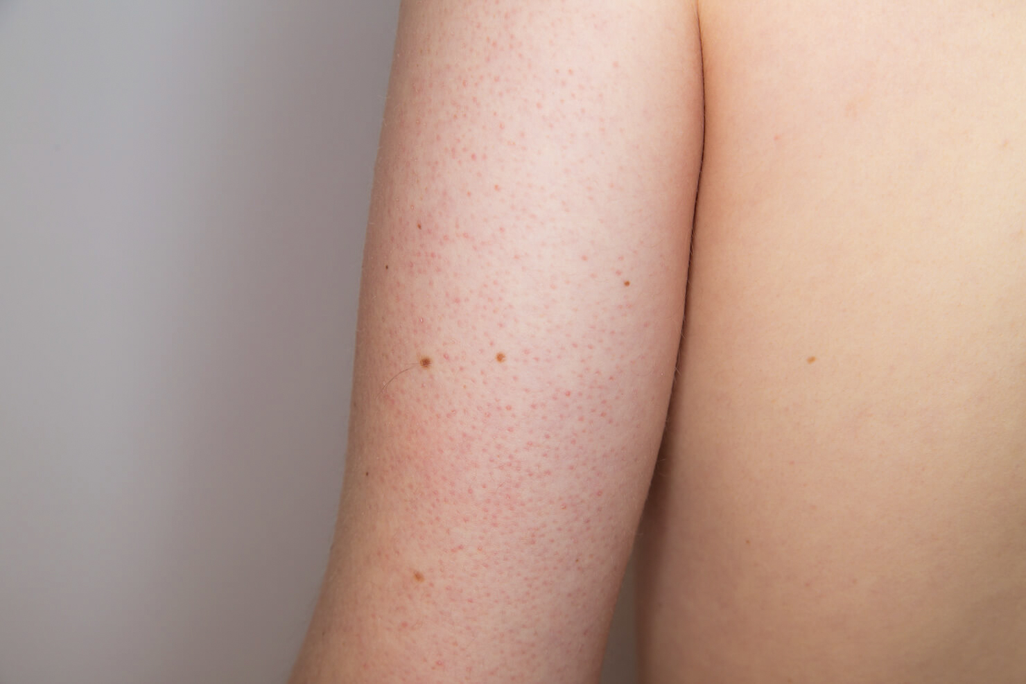 Keratosis pilaris red bumps on back of arm skin condition