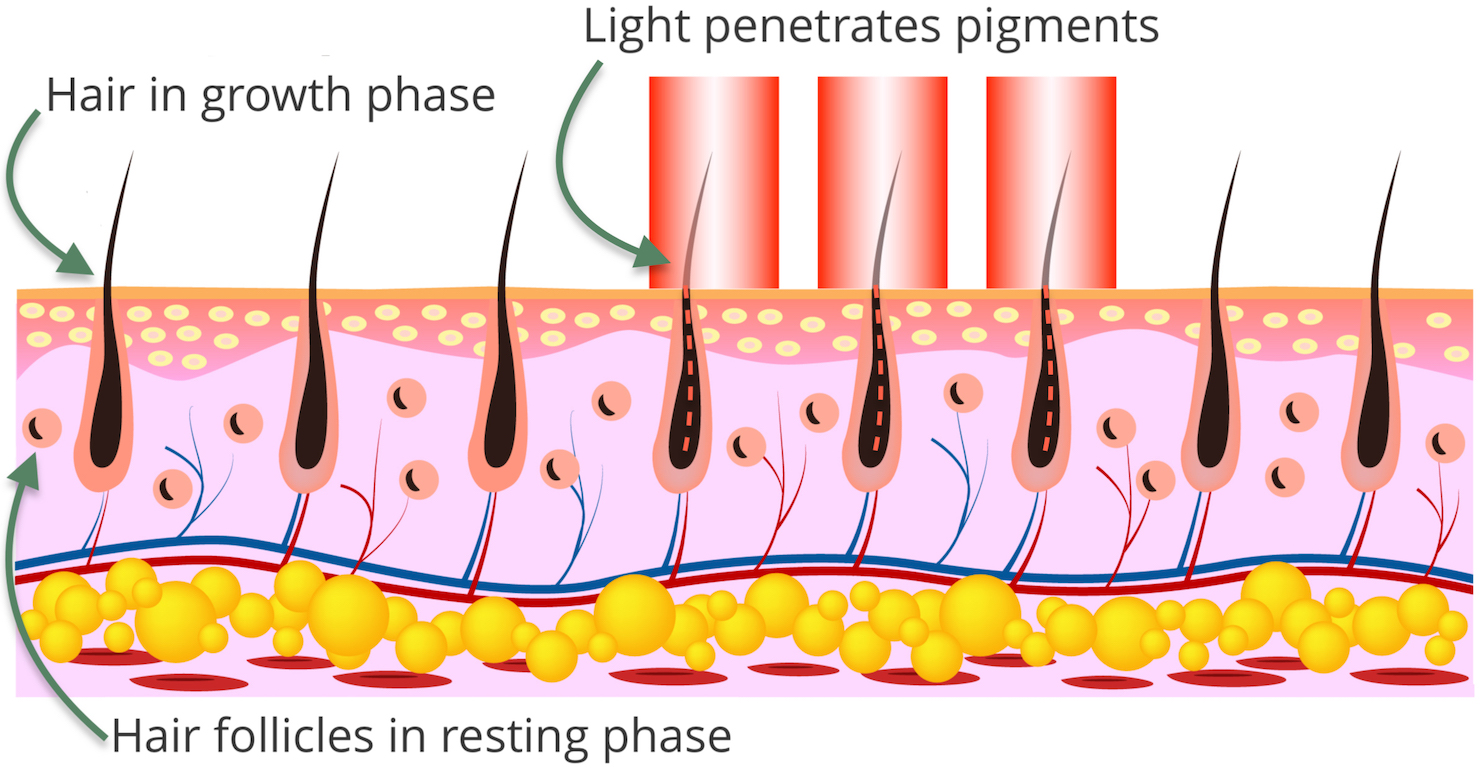 Laser hair removal diagram to show hair targeted through light pigments using our Surrey laser hair removal techniques