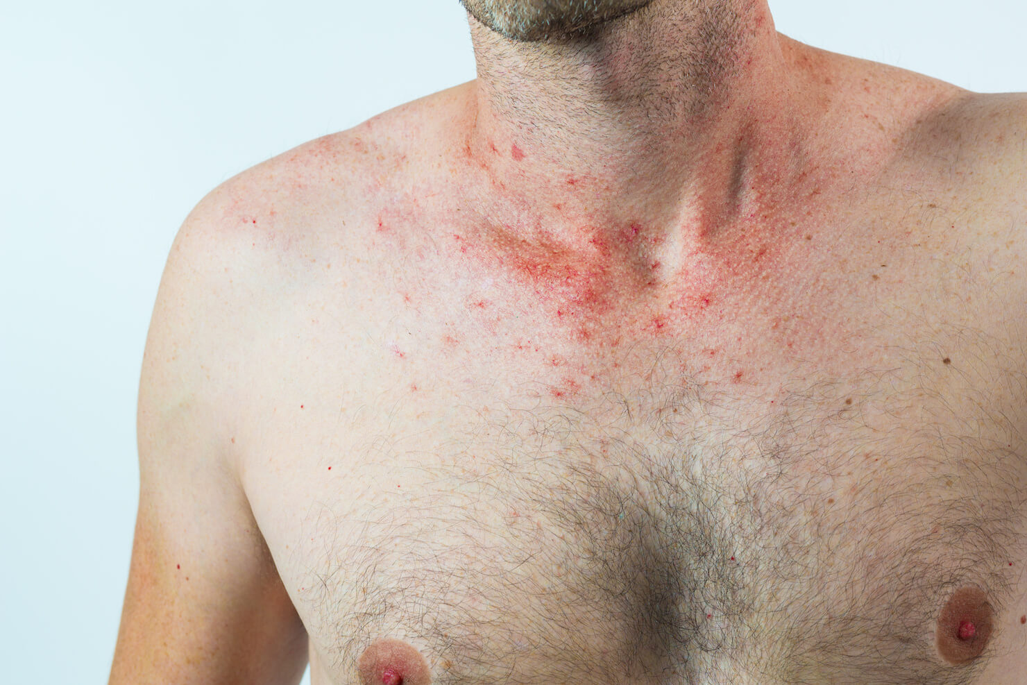 Telangiectasia red spots from broken capillaries forming spider veins