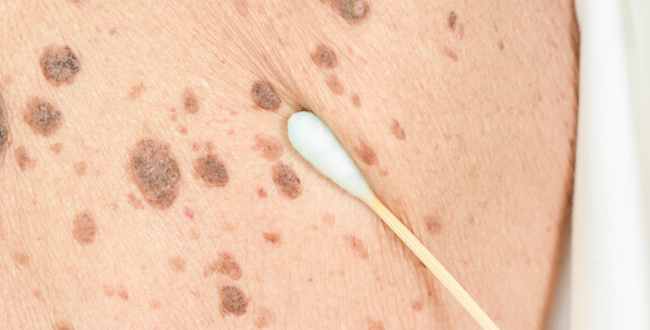 melasma and brown spots on skin with swab