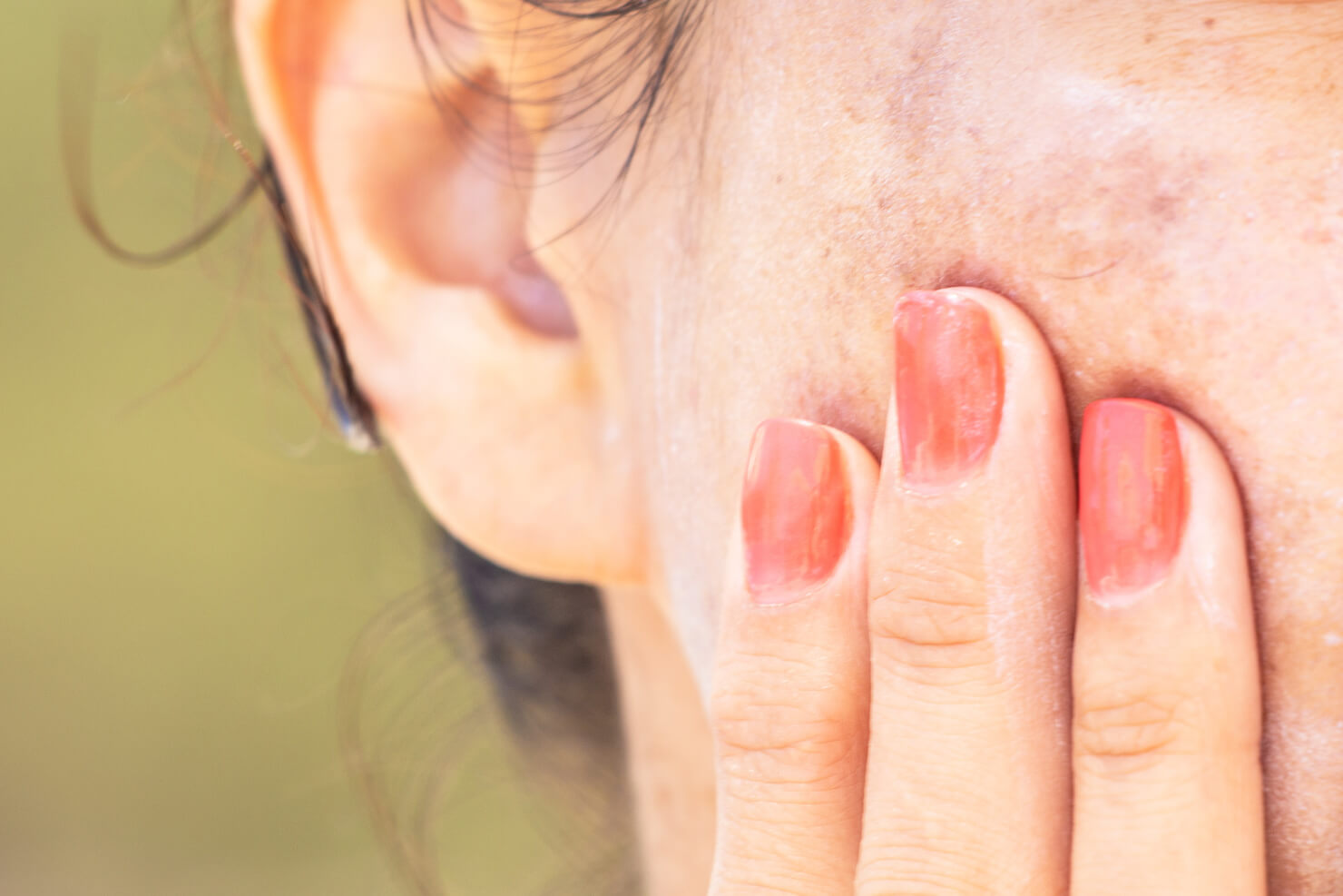 Blotchy skin pigmentation and discolouration cheek