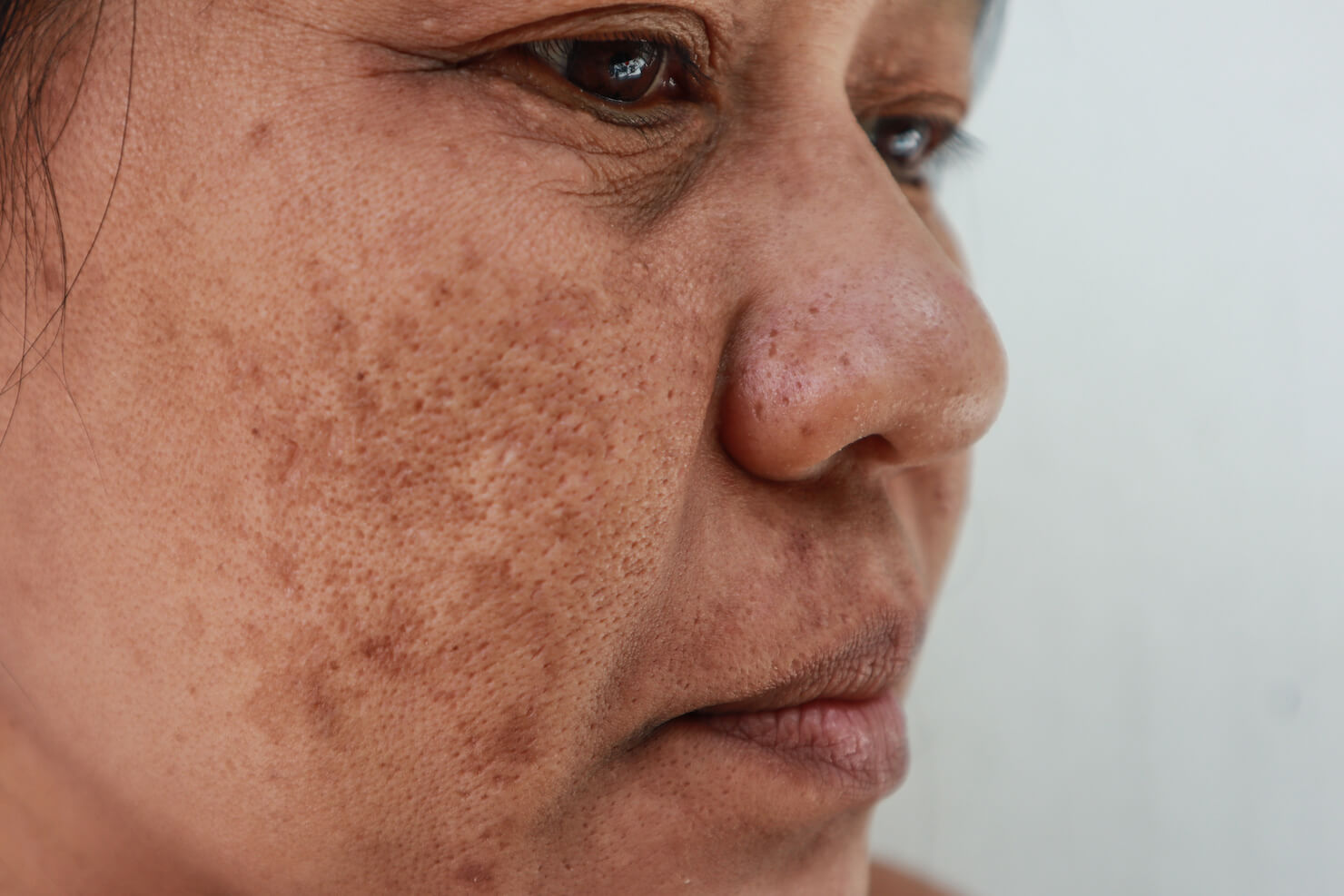 Melasma brown spots and patches on cheek of woman with darker skin tone