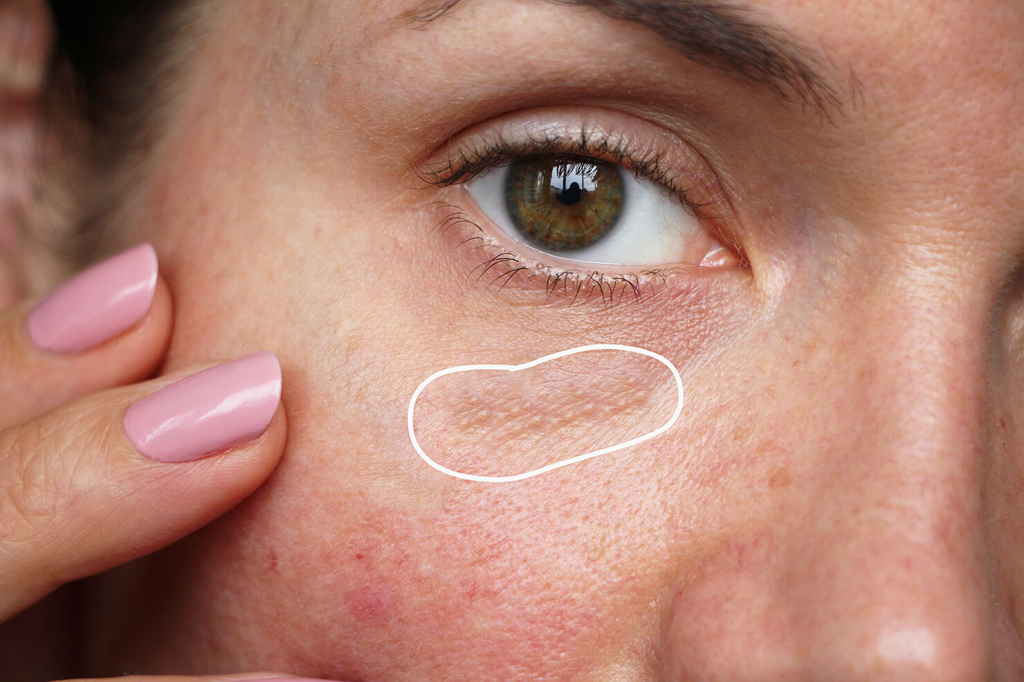 Keratosis Pilaris Under Eyes