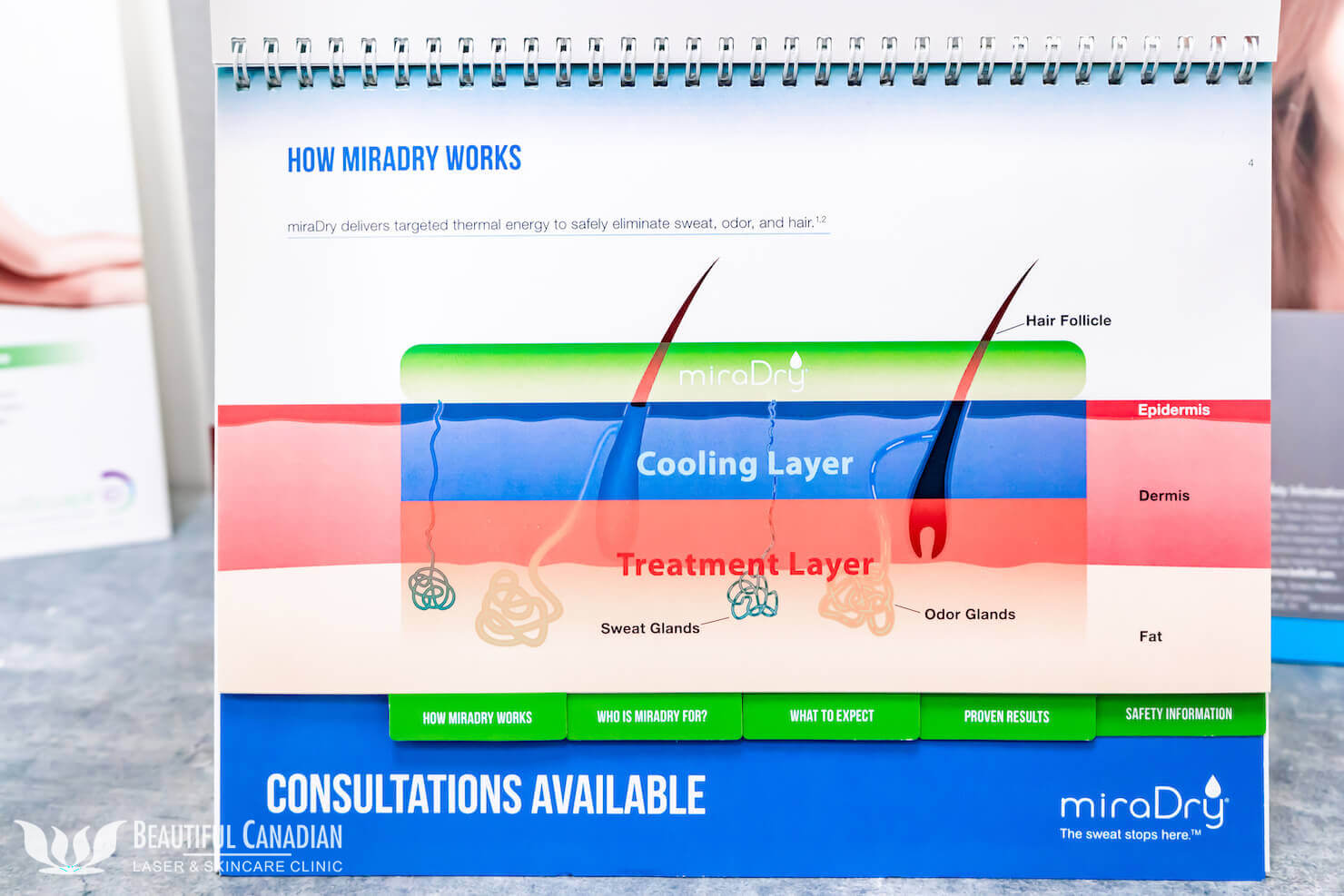 miraDry diagram showing treatment layers available at Surrey clinic