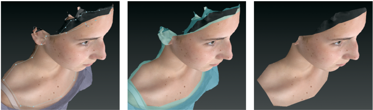 Multi-angle view of patient face and neck using the Vectra 3D image cut out