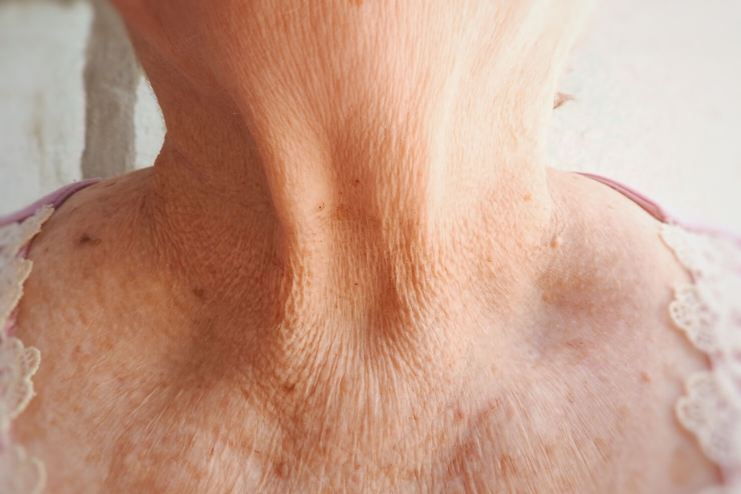 Neck wrinkles and aged sagging skin from solar elastosis and loss of collagen and elastin