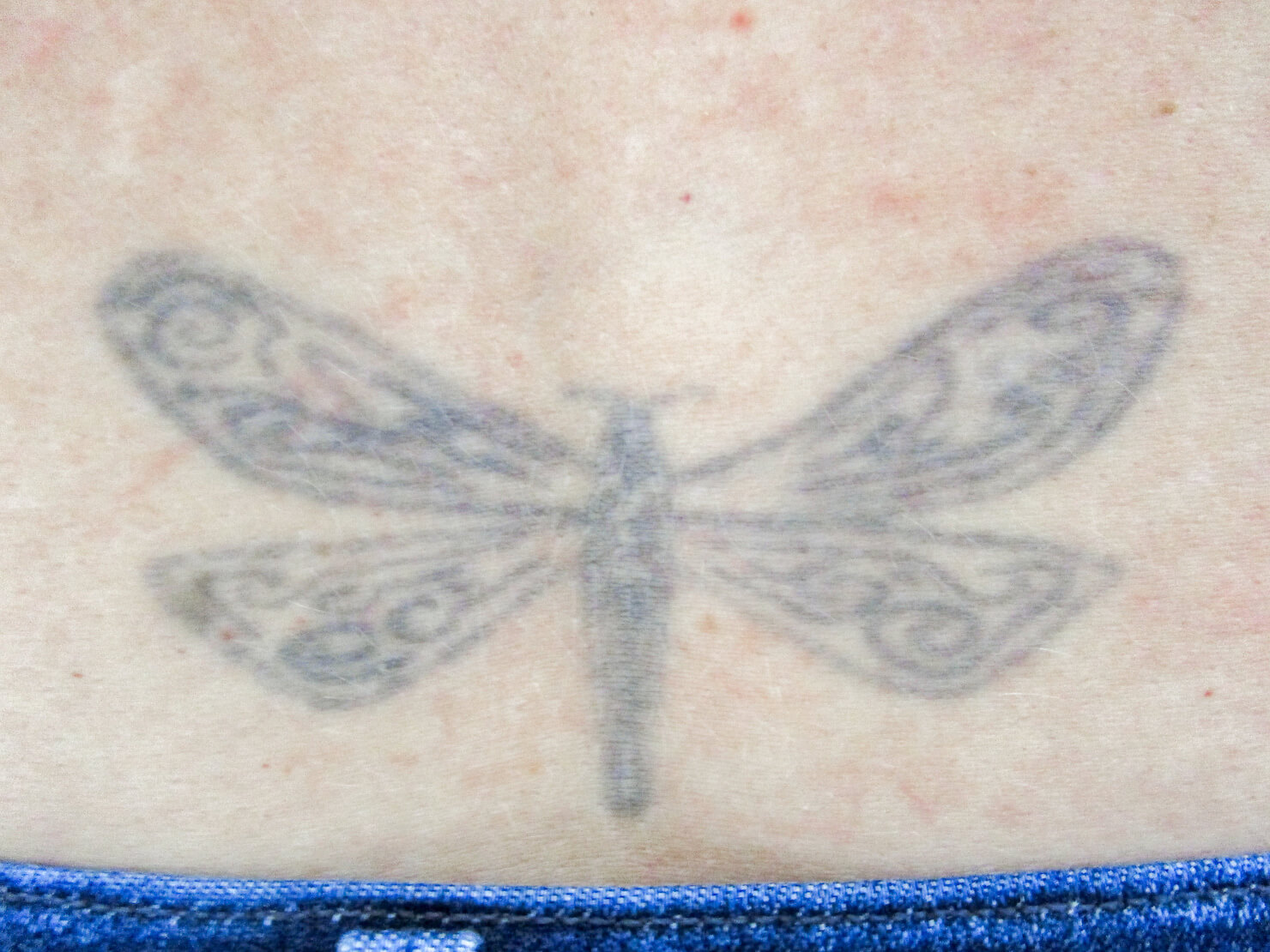 no treatment with enlighten laser tattoo removal in surrey - back butterfly before photo