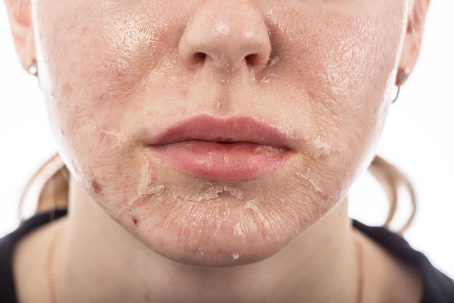 Skin shedding after a chemical peel facial treatment for acne scars and sun damaged skin to resurface skin with new cells