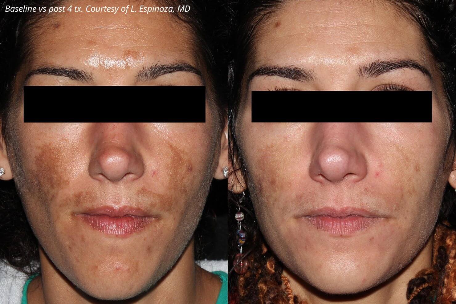 What Causes Melasma And How Can It Be Treated?