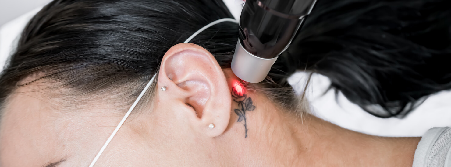 Vancouver Tattoo Removal w/ Latest Laser Technology | Surrey Tattoo Removal Vancouver Tattoo Removal w/ Latest Laser Technology | Surrey Tattoo Removal