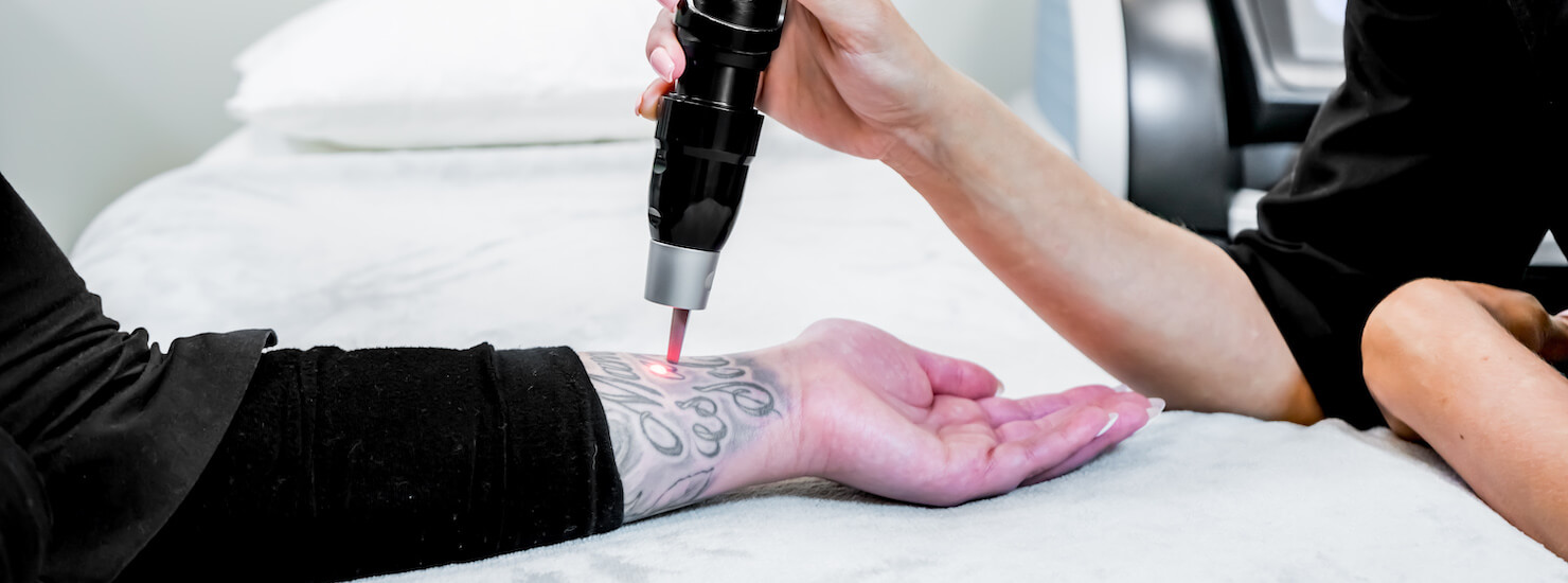 Vancouver PicoSure™ Fast Laser Tattoo Removal | Surrey, Delta, Langley,  White Rock