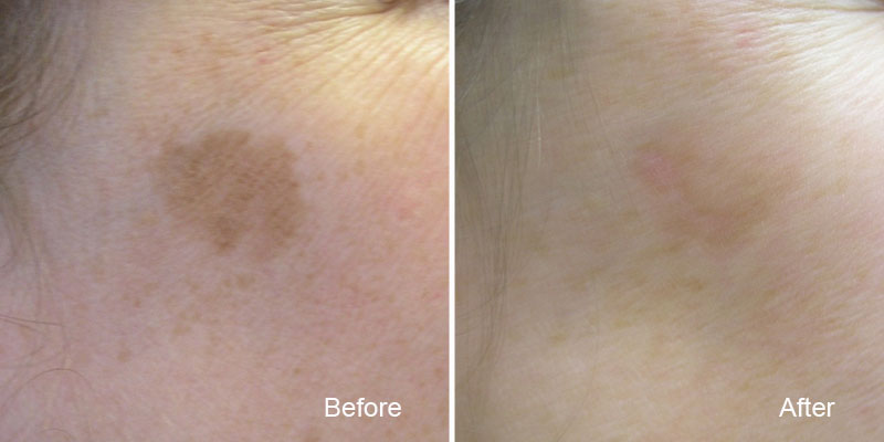 Remove Age Spots, Sun Spots, Skin Pigmentation at BC Laser