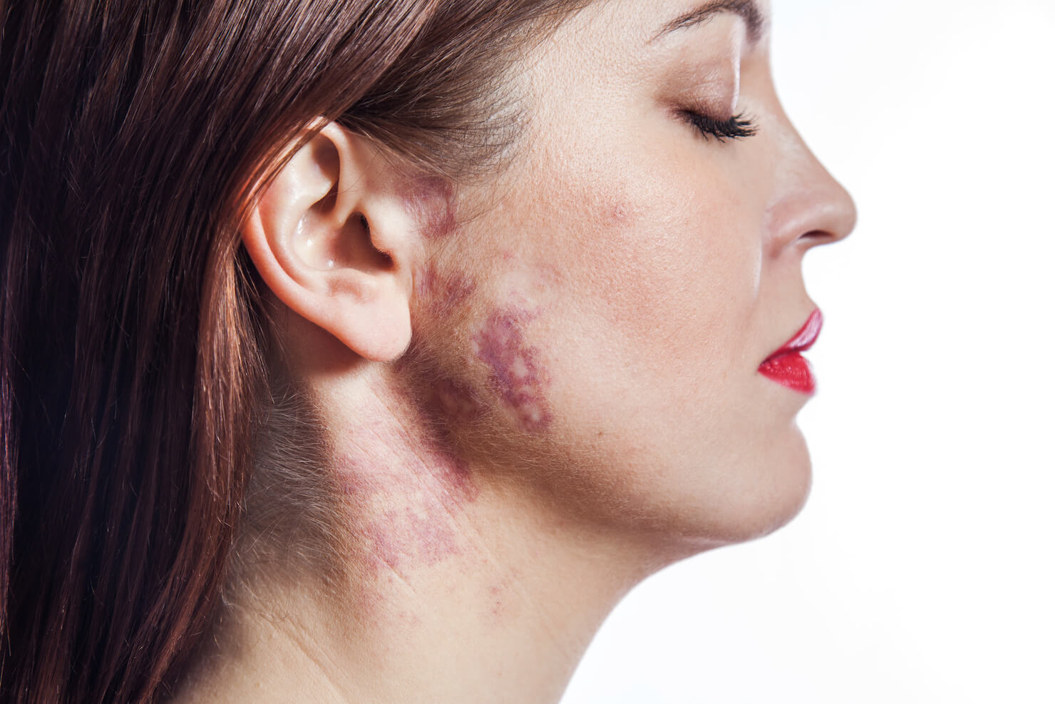 Port wine stain on female face - a red birth mark that is removable with treatments