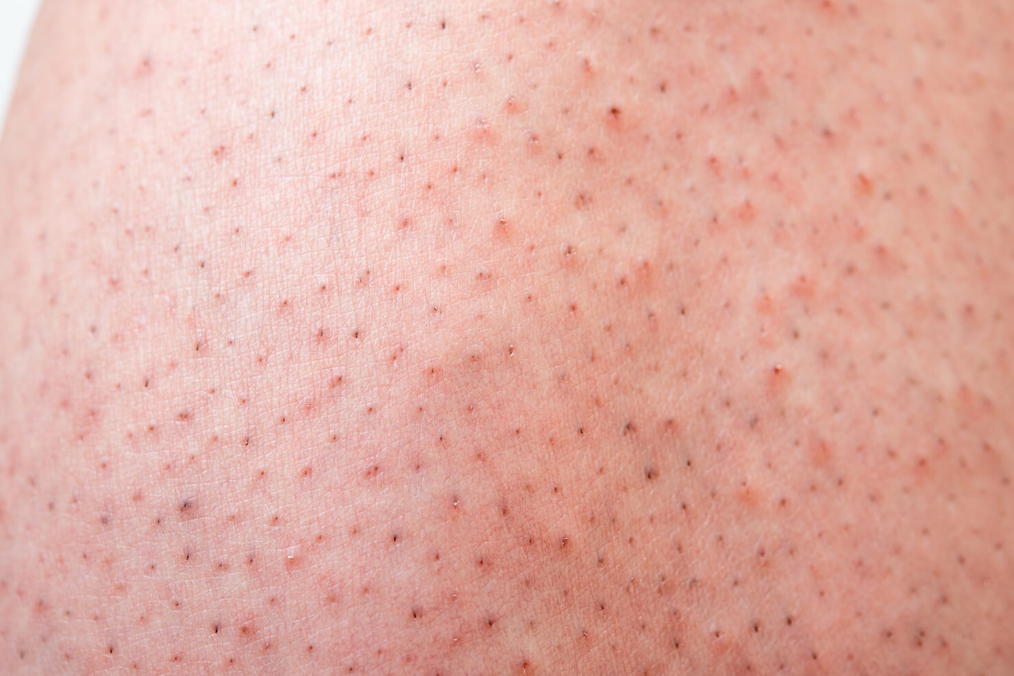 Close up of pseudofolliculitis razor bumps as red spots on the skin