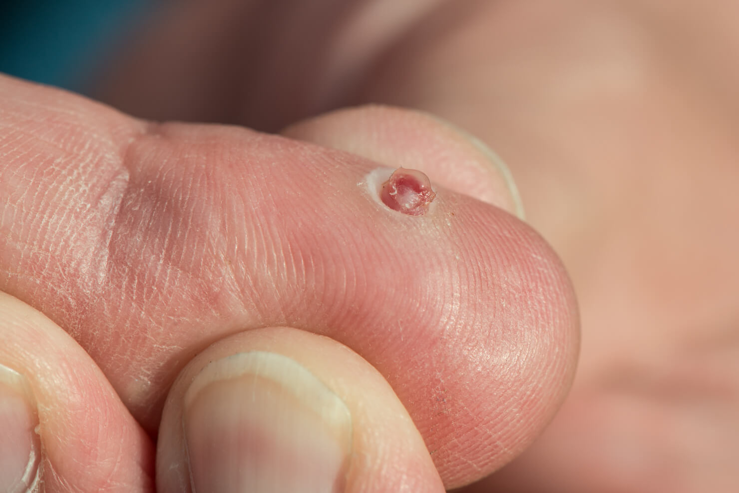 Pyogenic granuloma on finger as a red spot condition