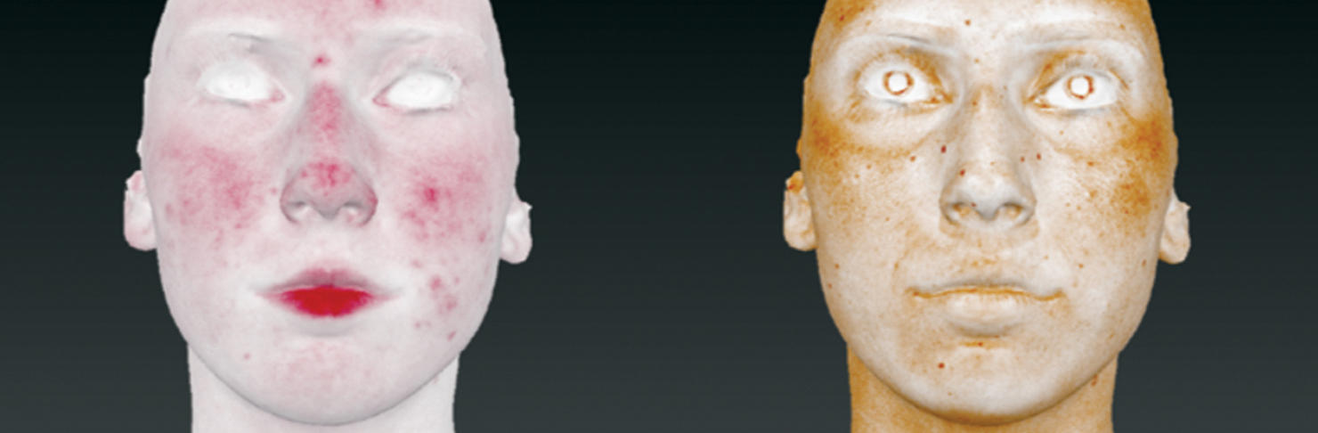 Vectra 3D system with RBX technology to show brown spots and red spots on face