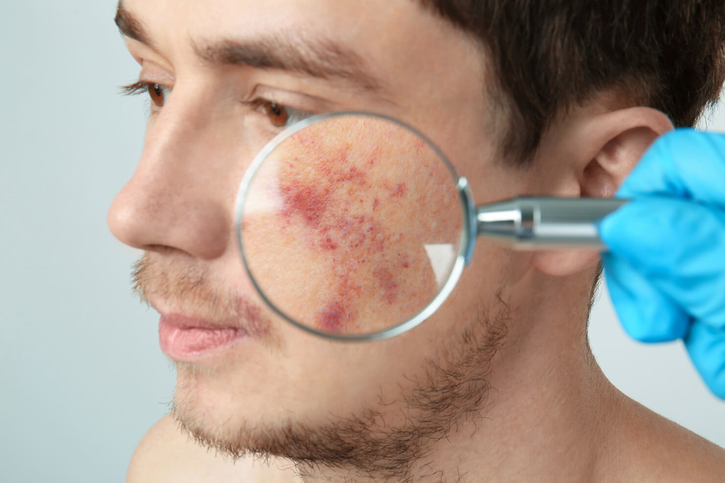 Red birthmark on cheek of male with magnifying glass