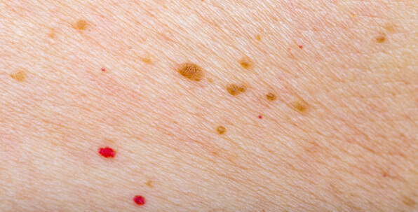 red spots on skin with brown spots