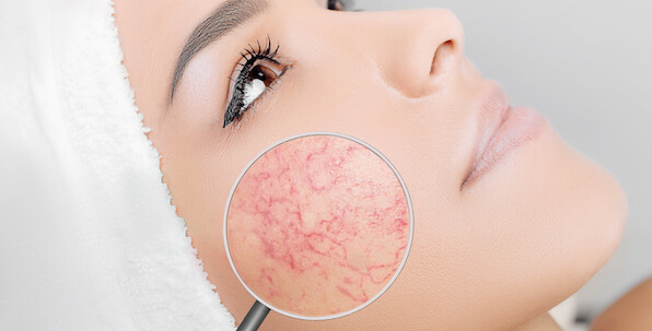 rosacea close up with magnifying glass on face