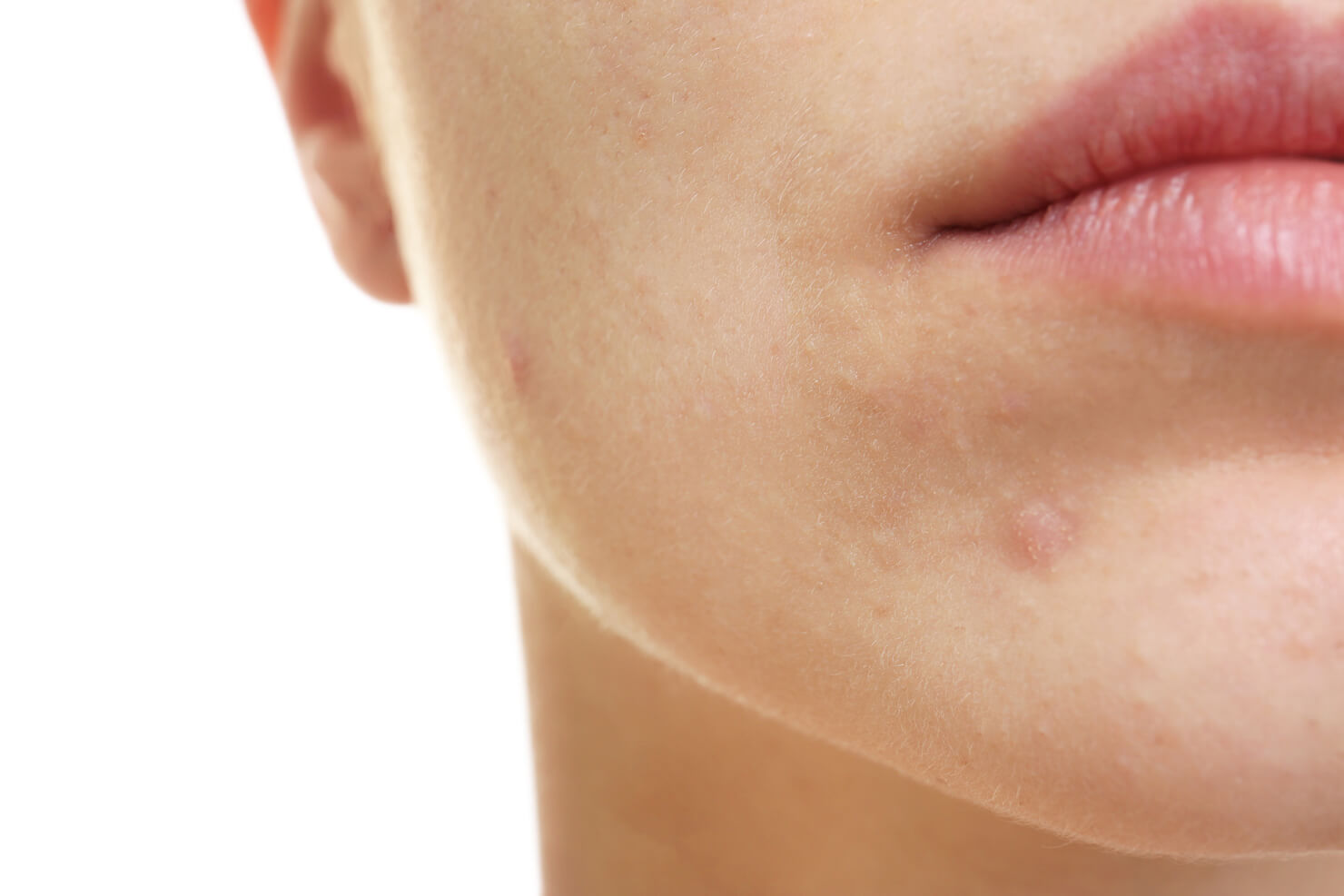 Stage 1 mild acne with some spots and healing acne macular scar