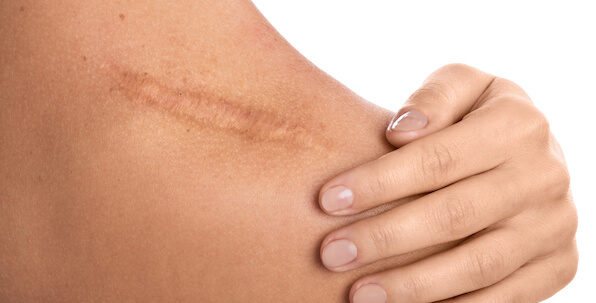 long scar formed on human shoulder back