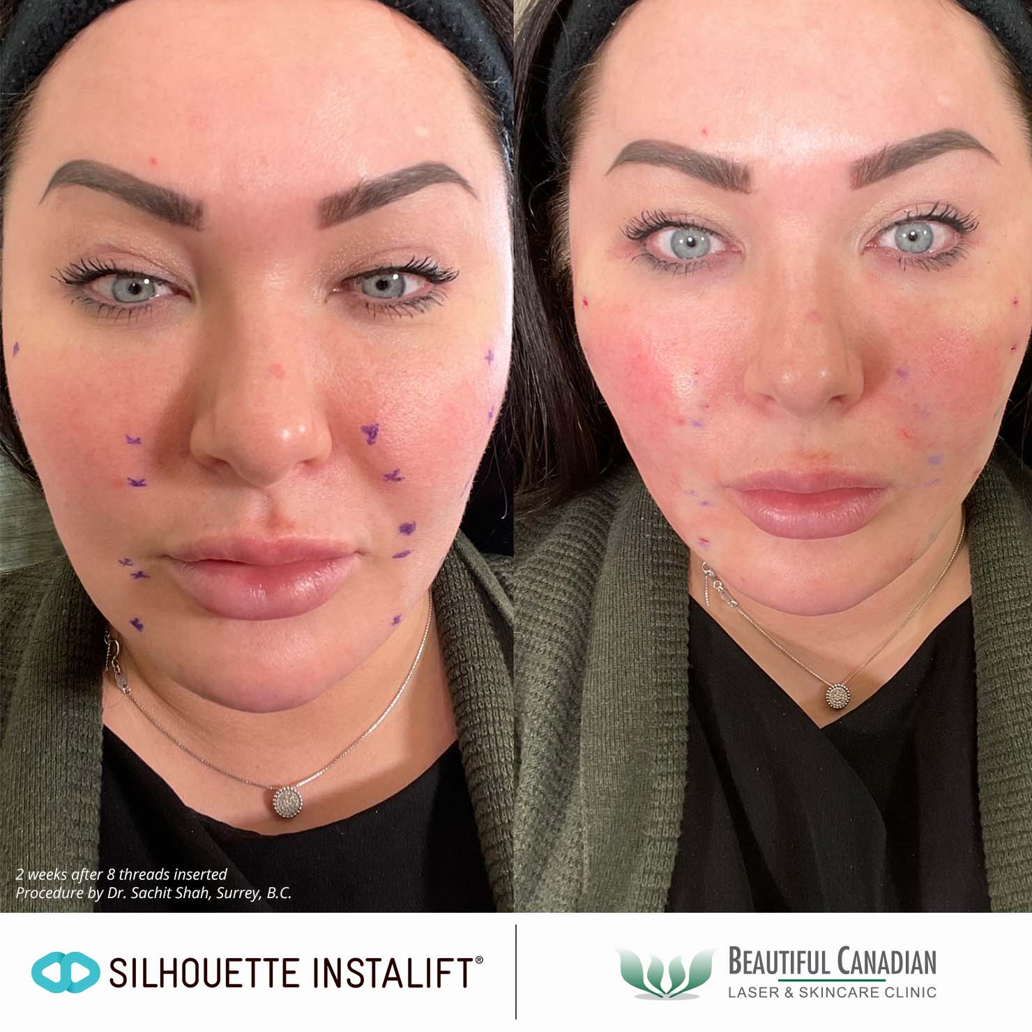 Vancouver Thread Lift Procedure in Surrey NonSurgical Cheek Lift