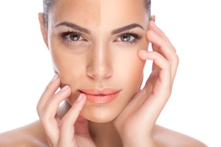 Skin Hyperpigmentation Treatments from BC Laser &amp; Skin ...