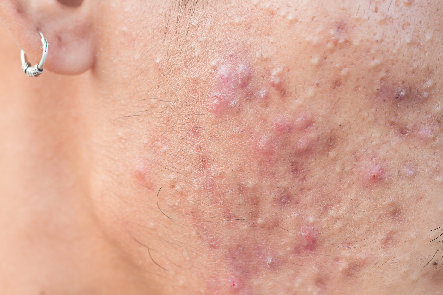 How to Treat Adult Acne (Plus Learn What Causes It To Begin With)