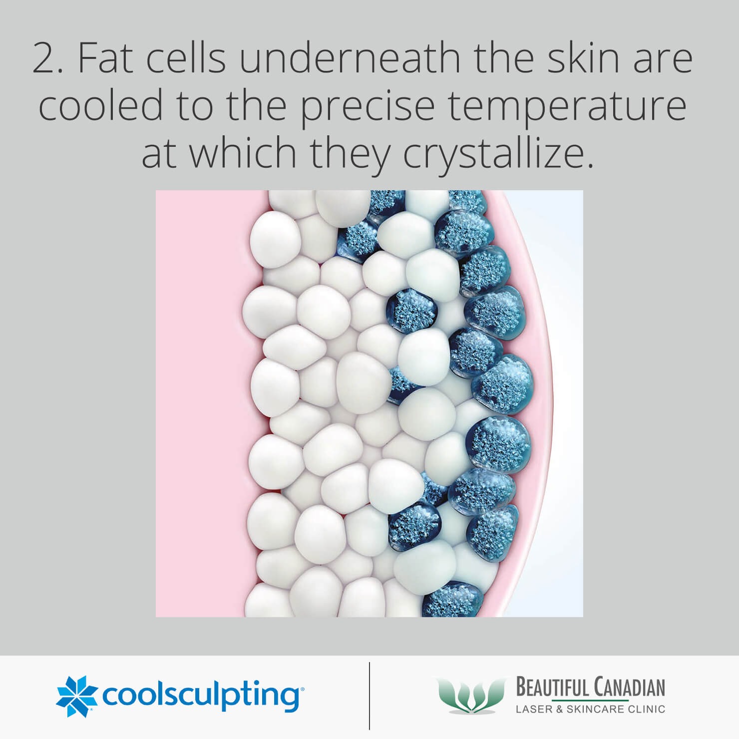 CoolSculpting® Vancouver w/ Cost Info Fat Freezing in Surrey BC Laser