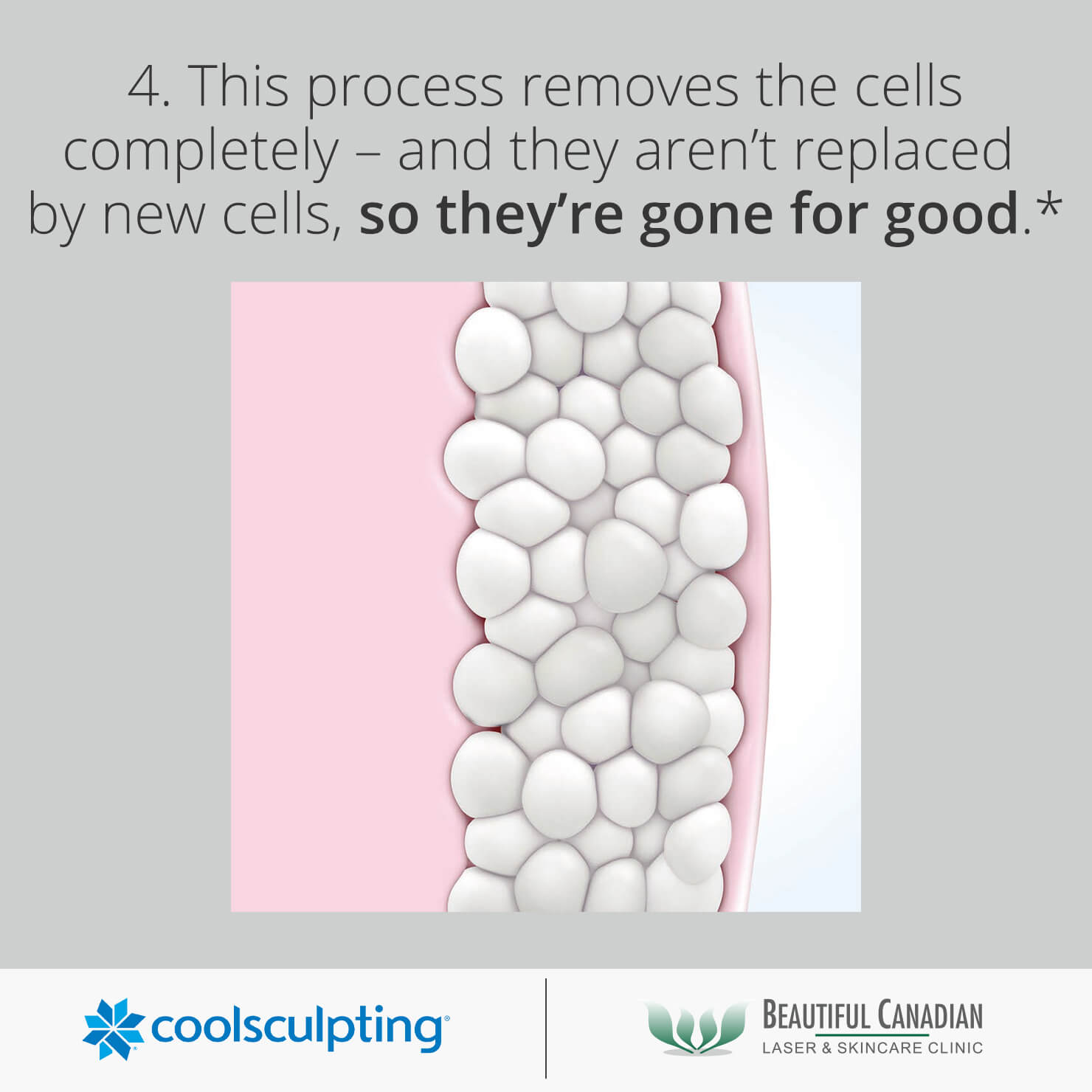 CoolSculpting® Vancouver w/ Cost Info Fat Freezing in Surrey BC Laser