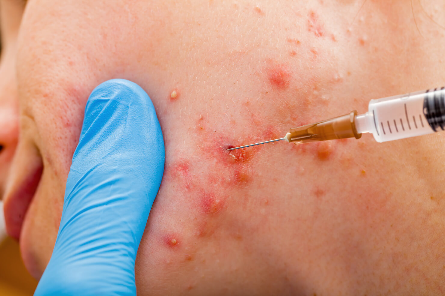 Injection of cystic acne nodule with steroid to reduce inflammation and prevent acne scarring