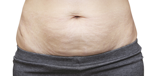 stretch marks on lower belly