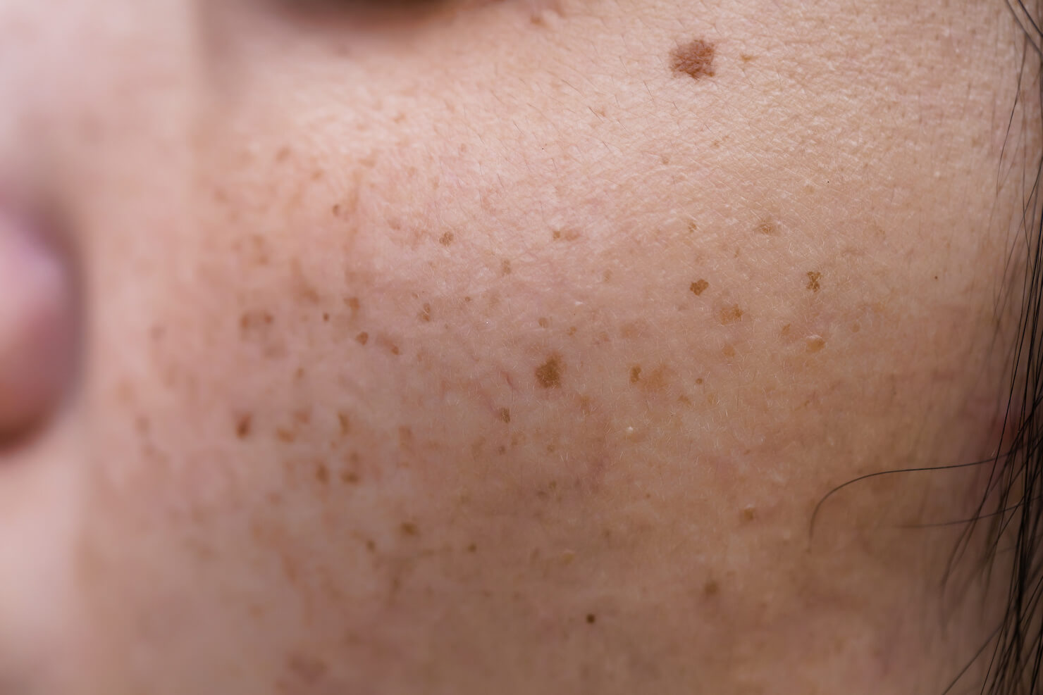 Sun damage on face - brown age spots also known as liver spots