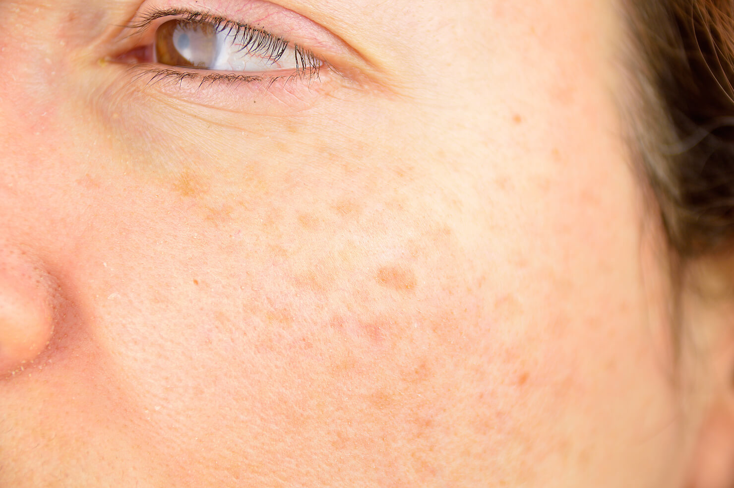 Brown spots from excess melanin or age spots resulting from sun damage