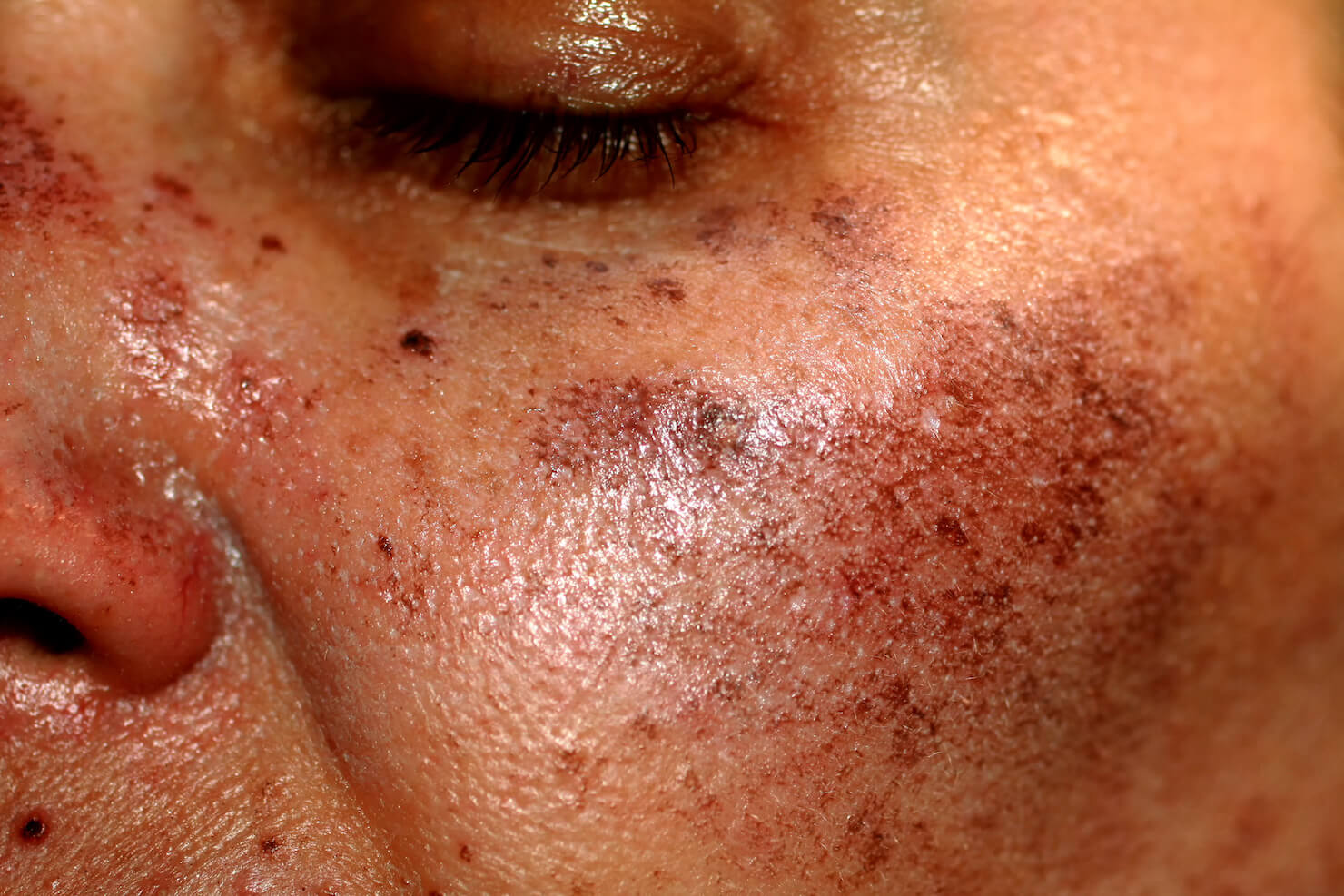 Solar lentigines sun damage and photo aging on dark skin