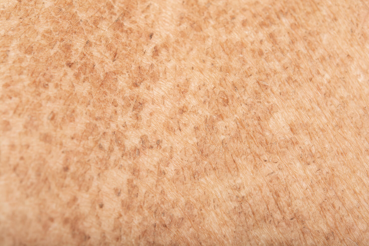 Poikiloderma freckled skin brown spots