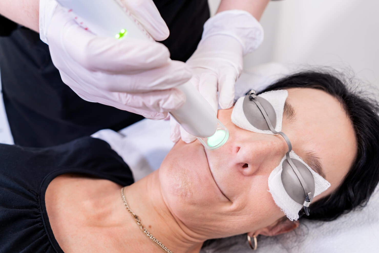 How Many Laser Treatments to Remove Upper Lip Hair?  