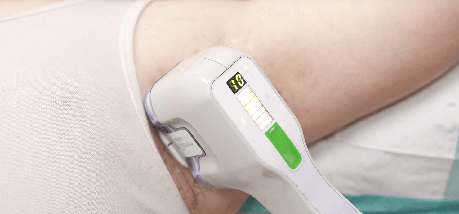 Surrey miraDry® Kill Underarm Sweat Glands & Odour Vancouver miraDry®